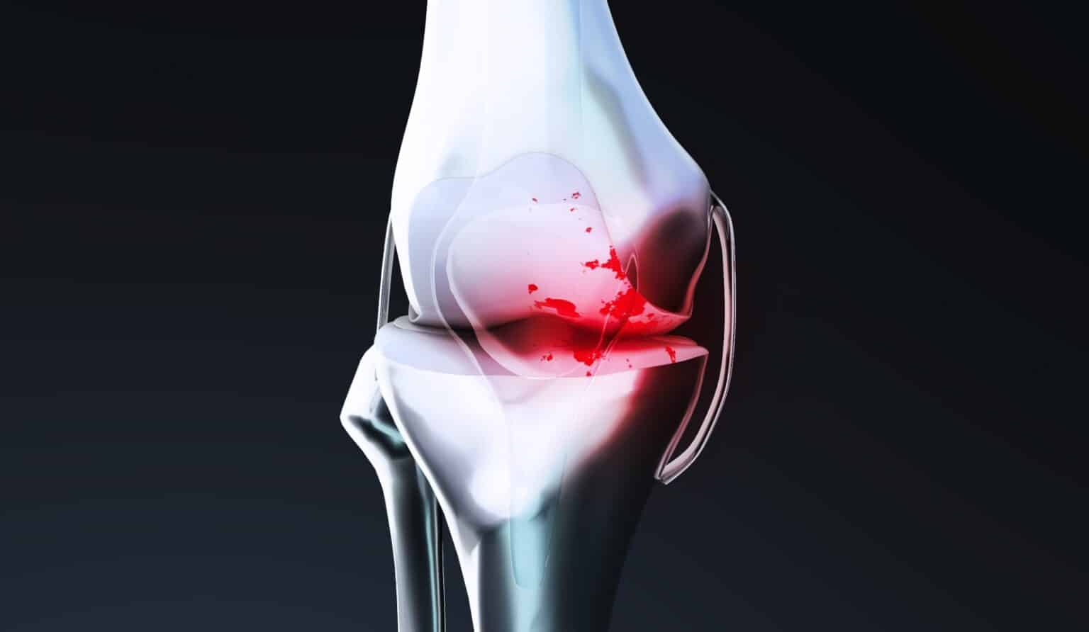 Chondropathie : causes et traitements | Dr Polle | Normandie