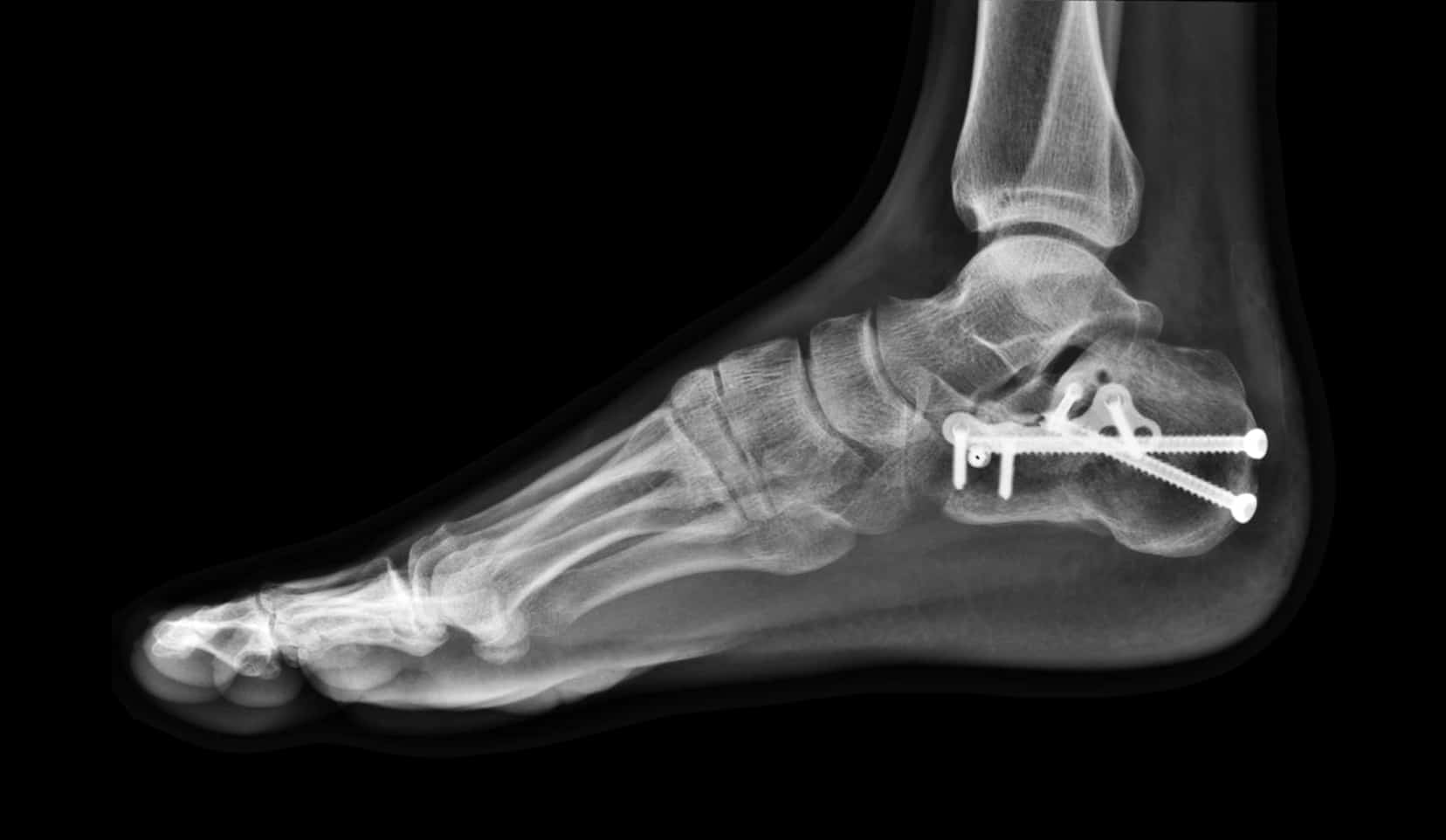 Ablation de vis,plaque ou broche | Chirurgie orthopédique | Bois-Guillaume | Dr Polle