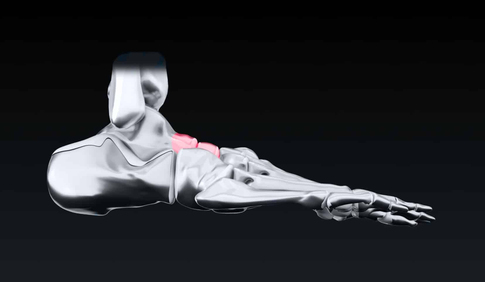 Arthrodèse talo-naviculaire, chirurgie pied | Chirurgien orthopédiste | Bois-Guillaume | Dr Polle