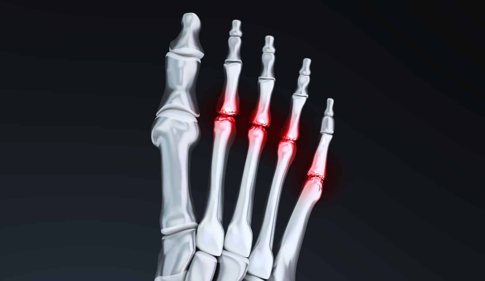 Arthrodèse inter-phalangienne : orthopédie | chirurgien orthopédique | Bois-Guillaume | Dr Polle
