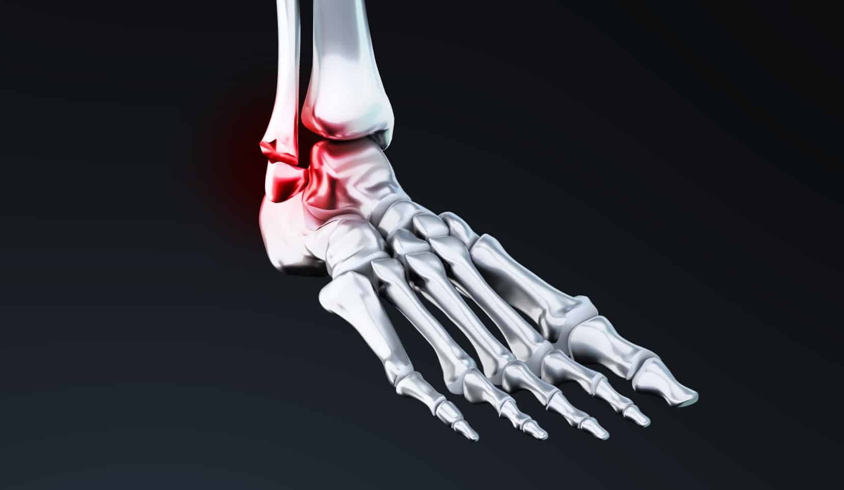 Chirugies de la cheville : orthopédiste | orthopédiste cheville | Bois-Guillaume | Dr Polle