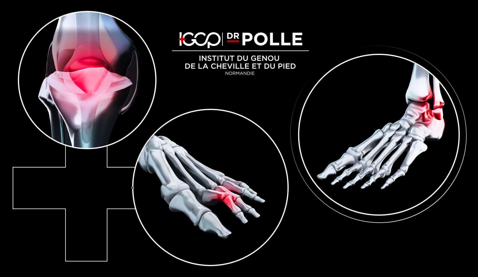 Les différentes chirurgies orthopédiques | chirurgie orthopédique et traumatologique | Bois-Guillaume | Dr Polle