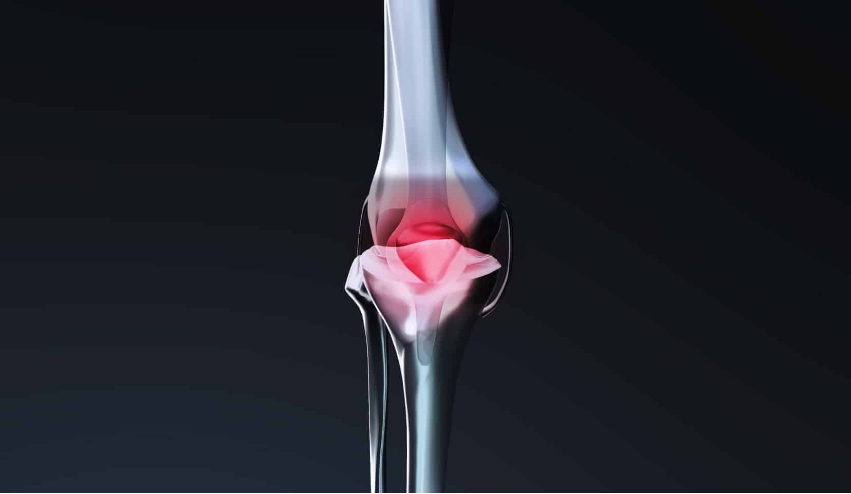 Lésion méniscale : causes et traitements | menisque genoux symptomes | Dr Polle | Bois-Guillaume