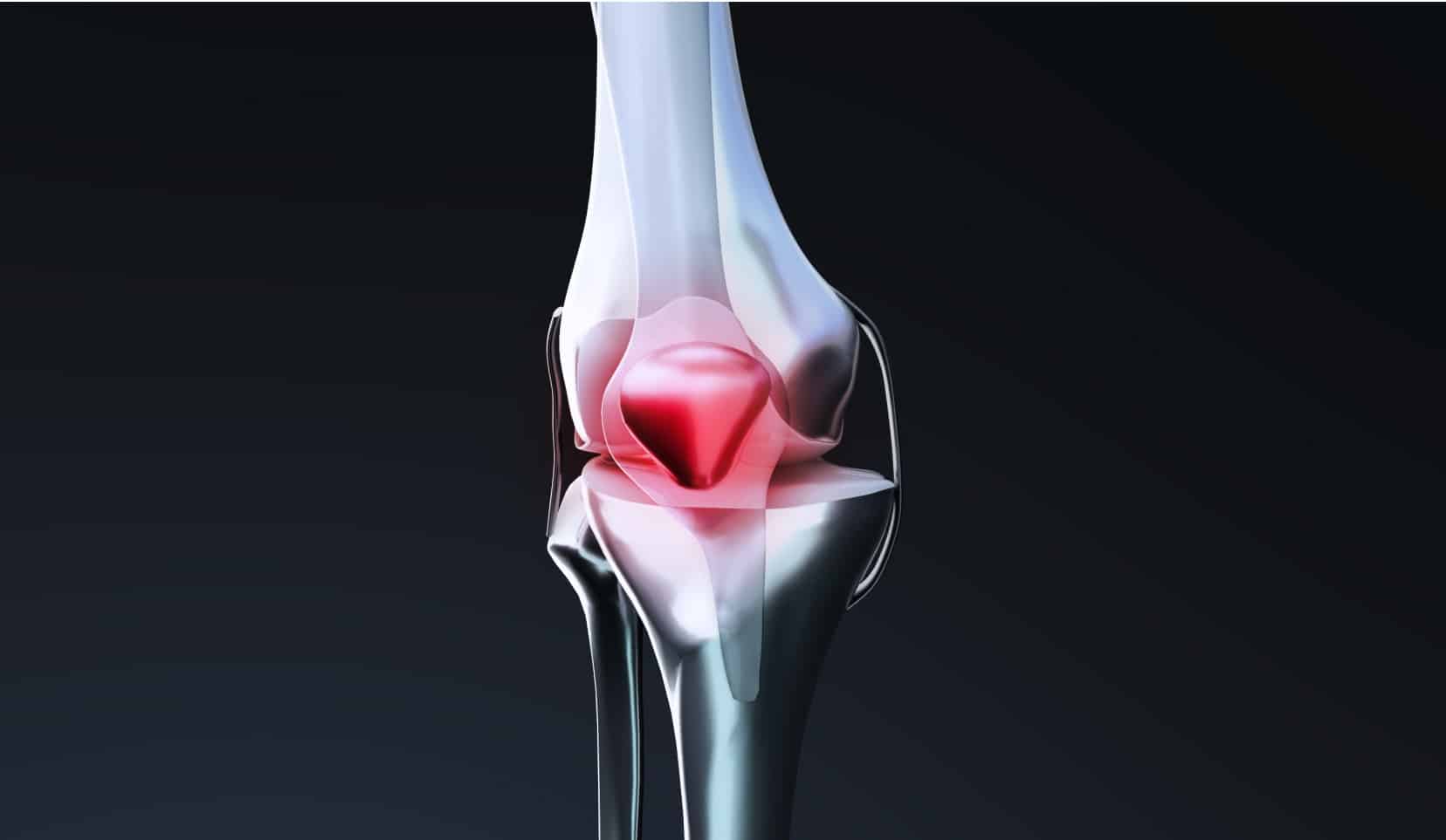 Luxation du genou : causes et traitements | luxation de la rotule | Dr Polle | Bois-Guillaume
