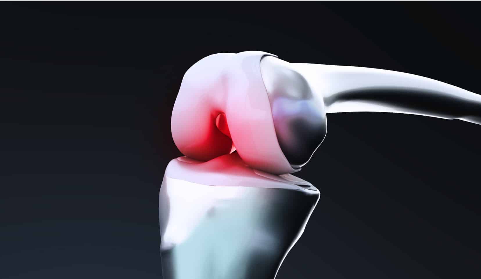 Nécrose du condyle interne : traitement | chirurgien orthopédiste | Dr Polle | Bois-Guillaume