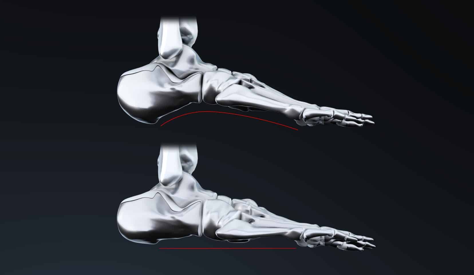 Pied plat et pied creux : traitement | Pied creux solution, douleur pied plat | Dr Polle | Bois-Guillaume