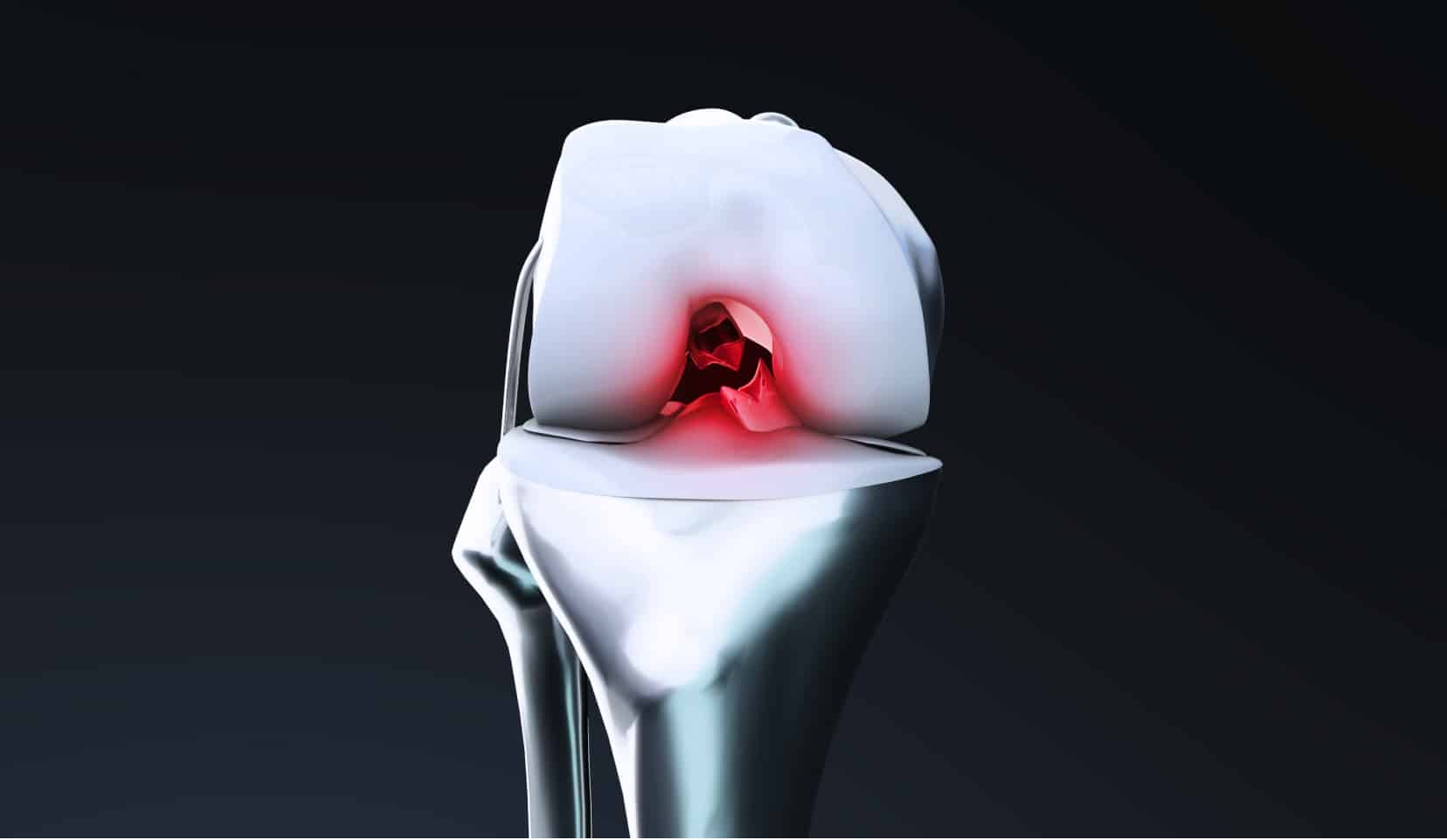 Rupture du ligament croisé antérieur | ligament croisé antérieur genou | Dr Polle | Bois-Guillaume