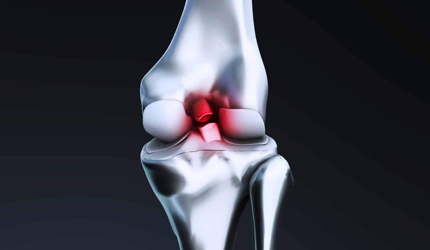 Rupture du ligament croisé postérieur | ligament postérieur du genou | Dr Polle | Bois-Guillaume