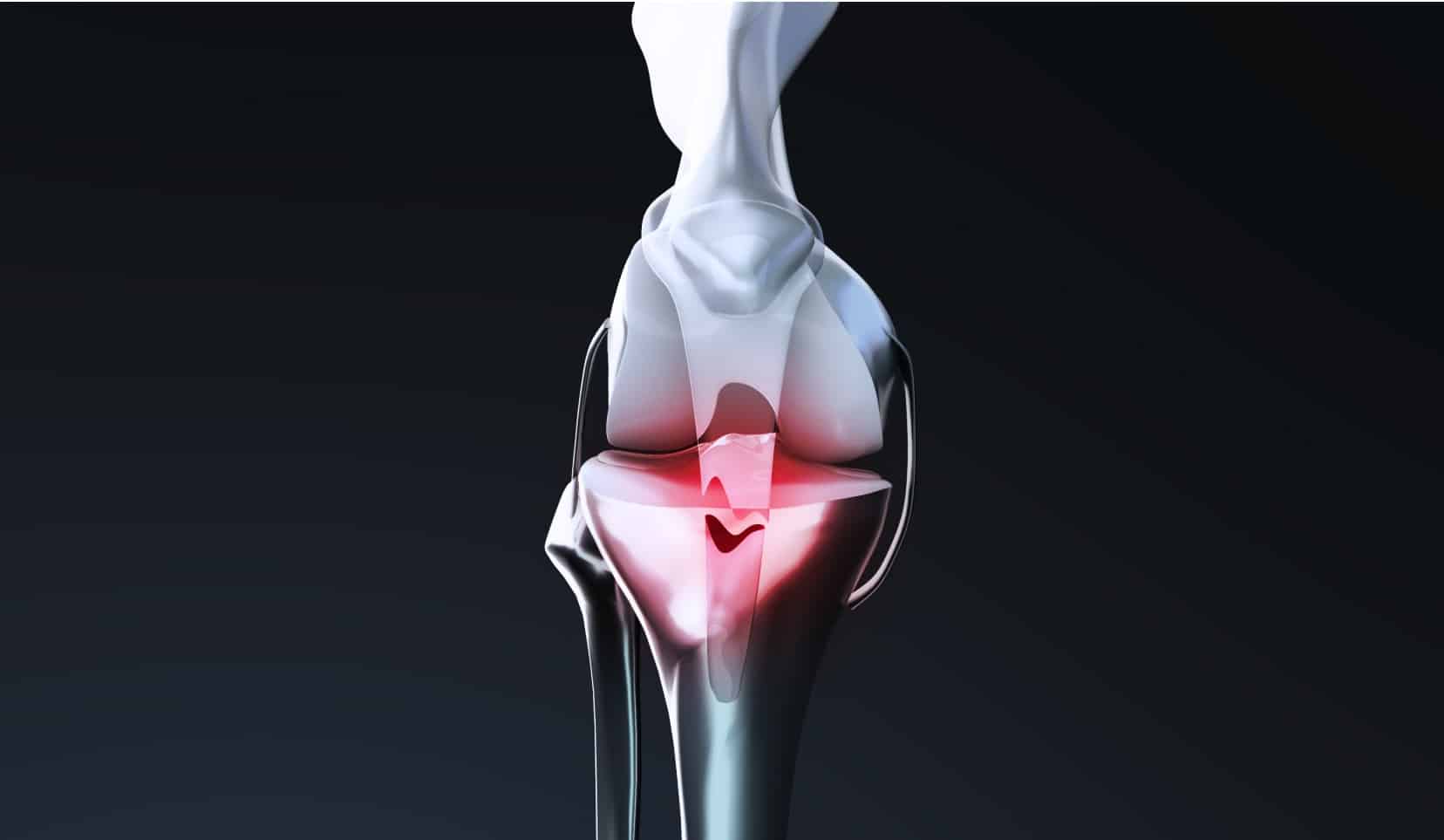 Rupture du tendon rotulien : traitement | Rupture tendon rotulien temps de guérison | Dr Polle | Bois-Guillaume
