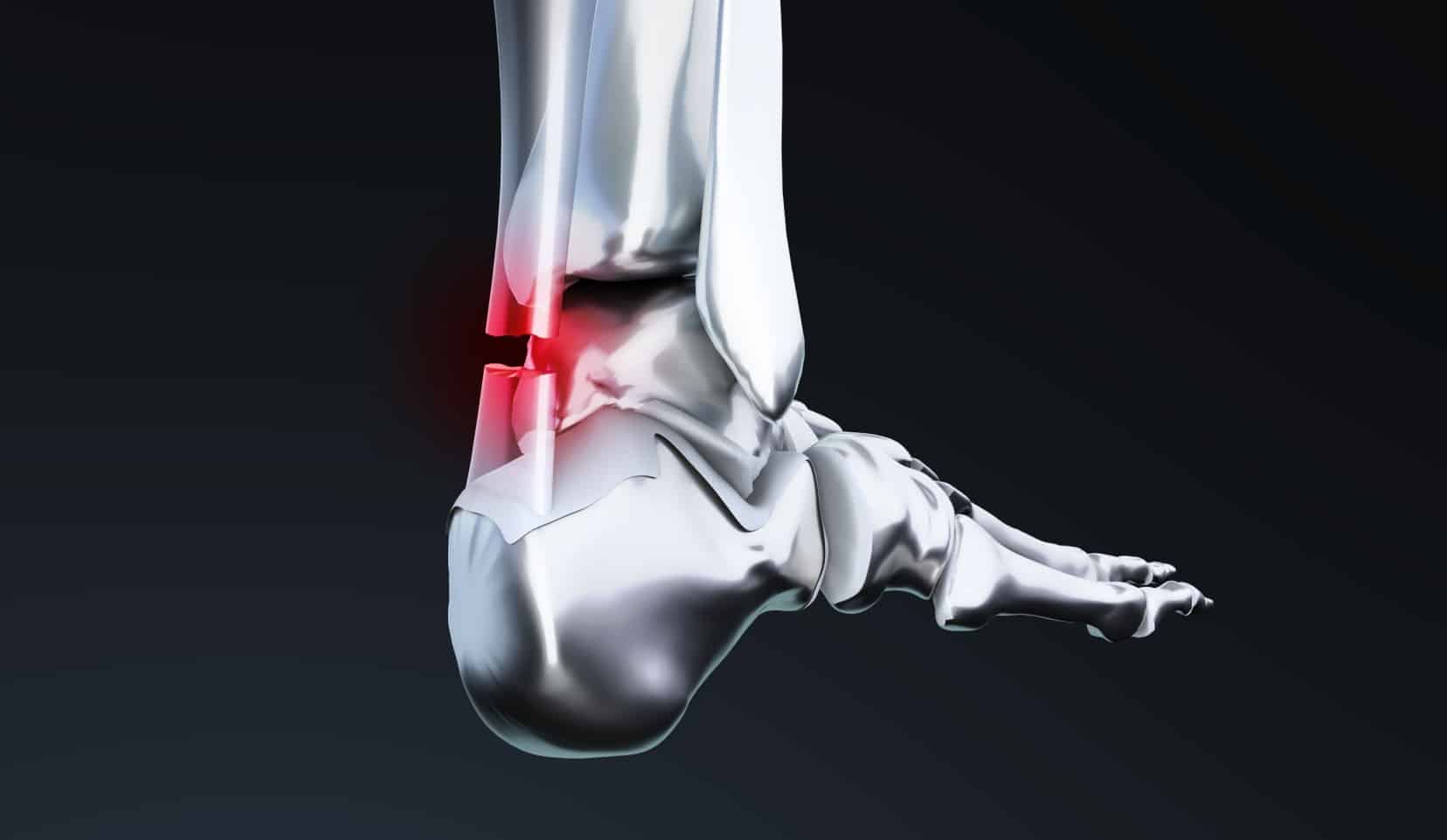 Suture tendon d'Achille : chirurgie pied | Chirurgien orthopédique | Bois-Guillaume | Dr Polle