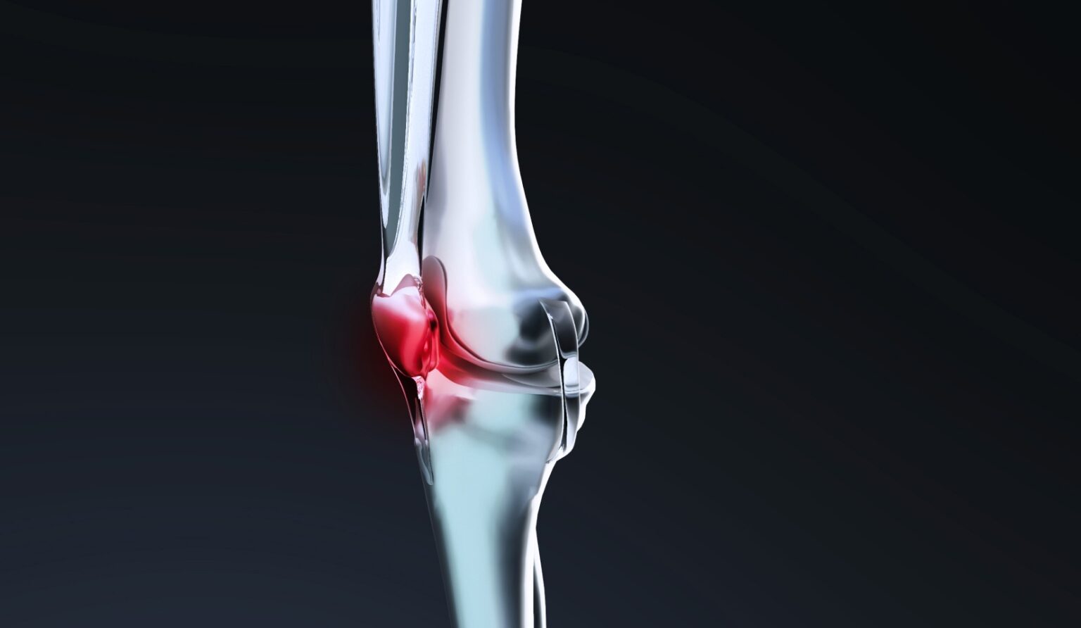 Tendinite du tendon rotulien traitement Dr Polle BoisGuillaume