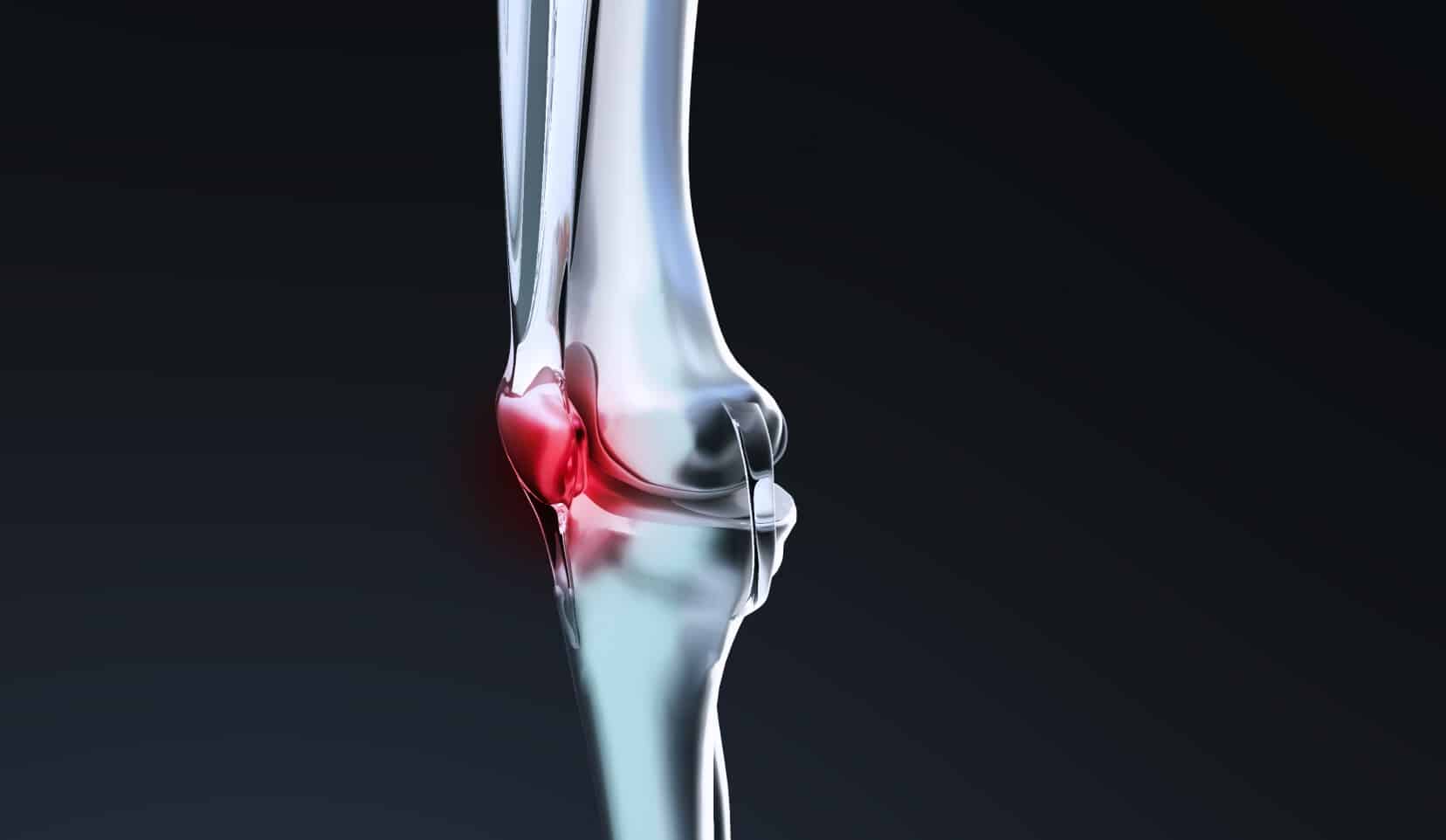 Tendinite du tendon rotulien : traitement | Tendon rotulien, douleur tendon rotulien | Dr Polle | Bois-Guillaume