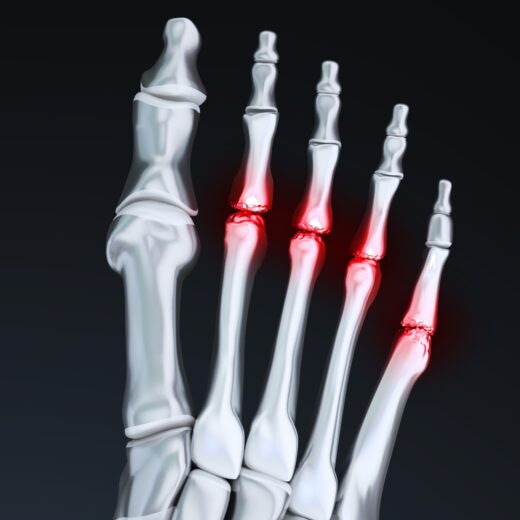 En cas d’excès d’appui au niveau de l’avant pied et les douleurs attenantes à ce problème, le chirurgien orthopédique a recours à une section ou une ablation des têtes métatarsiennes.