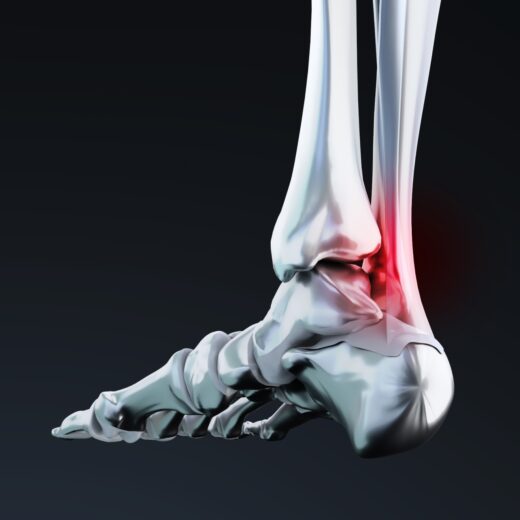 Une intervention chirurgicale de peignage du tendon d’Achille a lieu en cas de tendinite chronique du tendon d’Achille lorsque des techniques médicales (semelles orthopédiques, kinésithérapie) n’ont pas fonctionné.