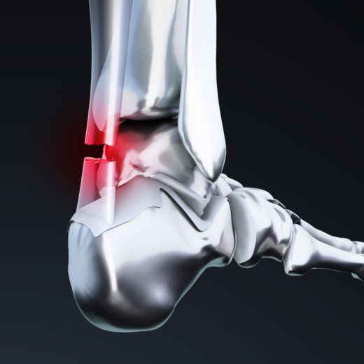 A la suite d’un effort physique brutal et de sollicitations répétées, le tendon d’Achille peut se rompre nécessitant une intervention chirurgicale. L’opération consiste à suturer les deux extrémités du tendon pour le raccrocher au muscle.