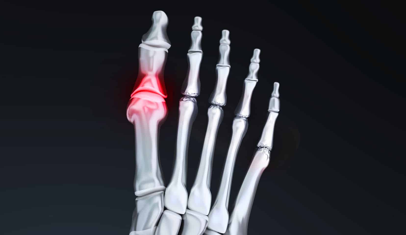 Ostéotomie du premier métatarsien | Chirurgie orthopédique | Bois-Guillaume | Dr Polle