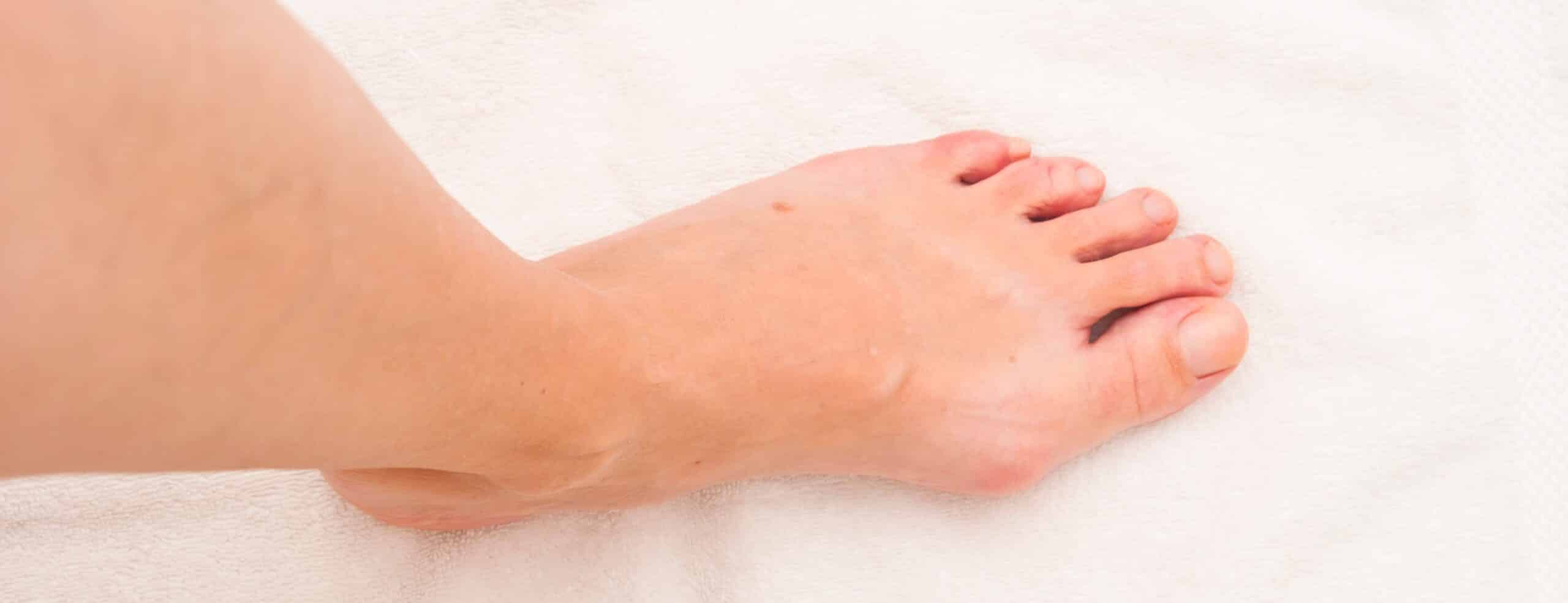 Comment prévenir l’hallux valgus ?|Dr Polle | Normandie