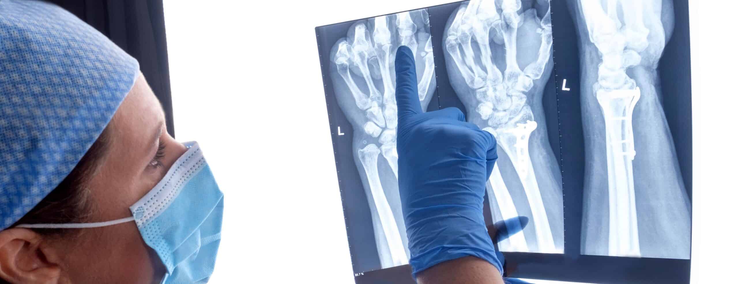 Traitement fractures osseuses - Dr Polle | Normandie