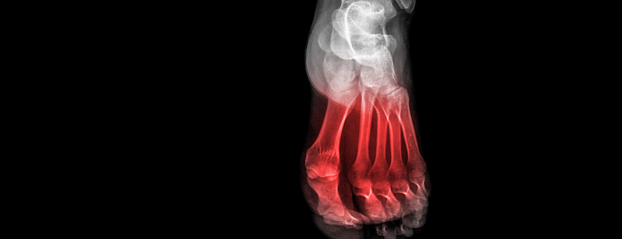 Fracture de fatigue - Dr Polle | Normandie