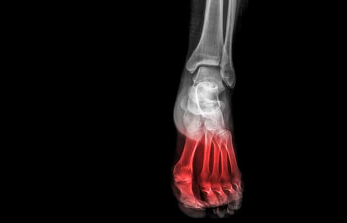 Fracture de fatigue - Dr Polle | Normandie