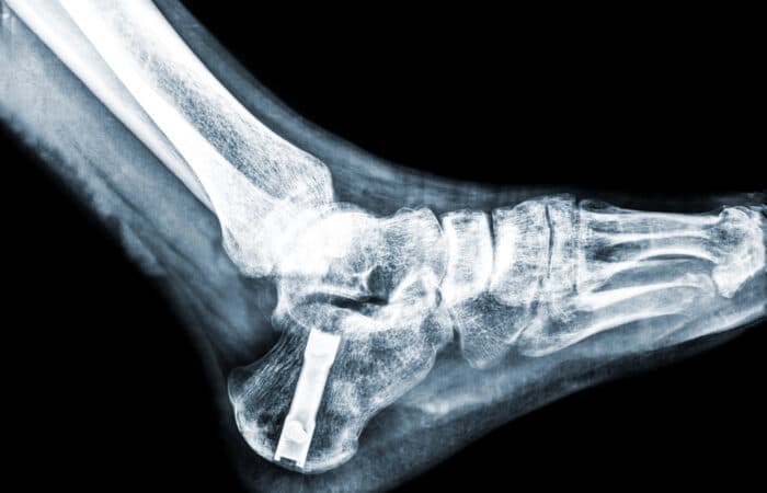 Quand se faire poser une prothèse de cheville ?| Dr Polle | Normandie